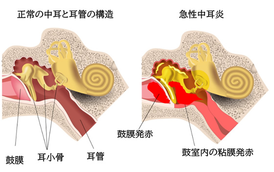 急性（化膿性）中耳炎