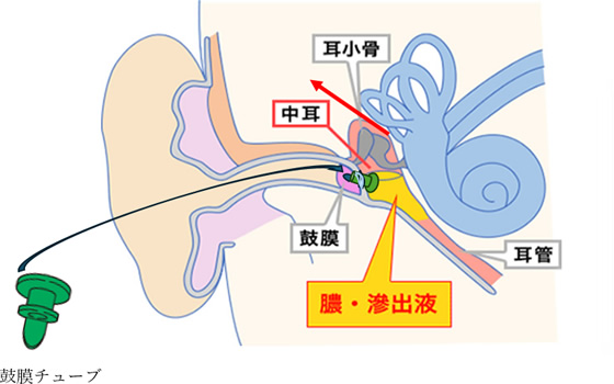 鼓膜チューブ挿入術