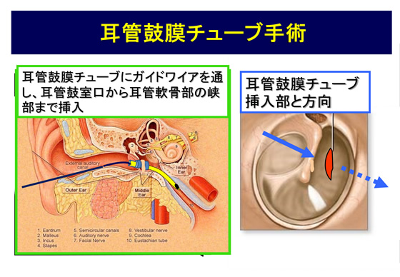 耳管鼓膜チューブ手術