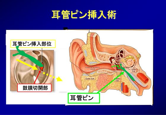 耳管ピン挿入術（耳管内補綴材挿入術）