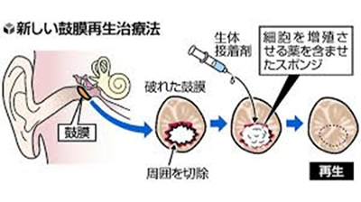 鼓膜穿孔閉鎖術（リティンパ使用）