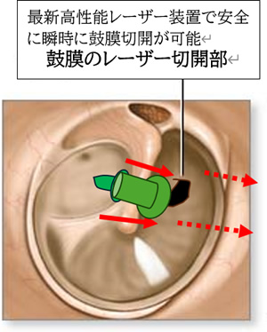 鼓膜チューブ挿入術